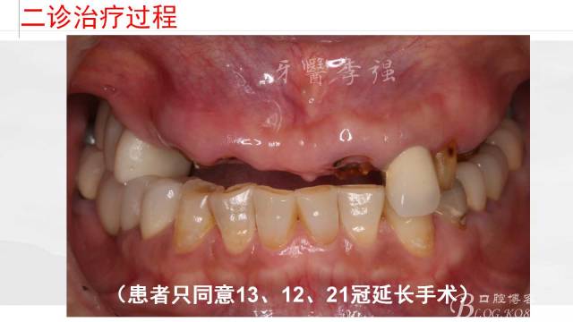 最新攻牙技术，革新牙科治疗的未来之路