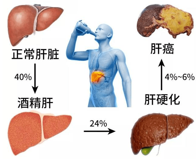 酒精肝最新研究、预防与治疗进展